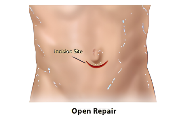 Umbilical hernia repair sequence